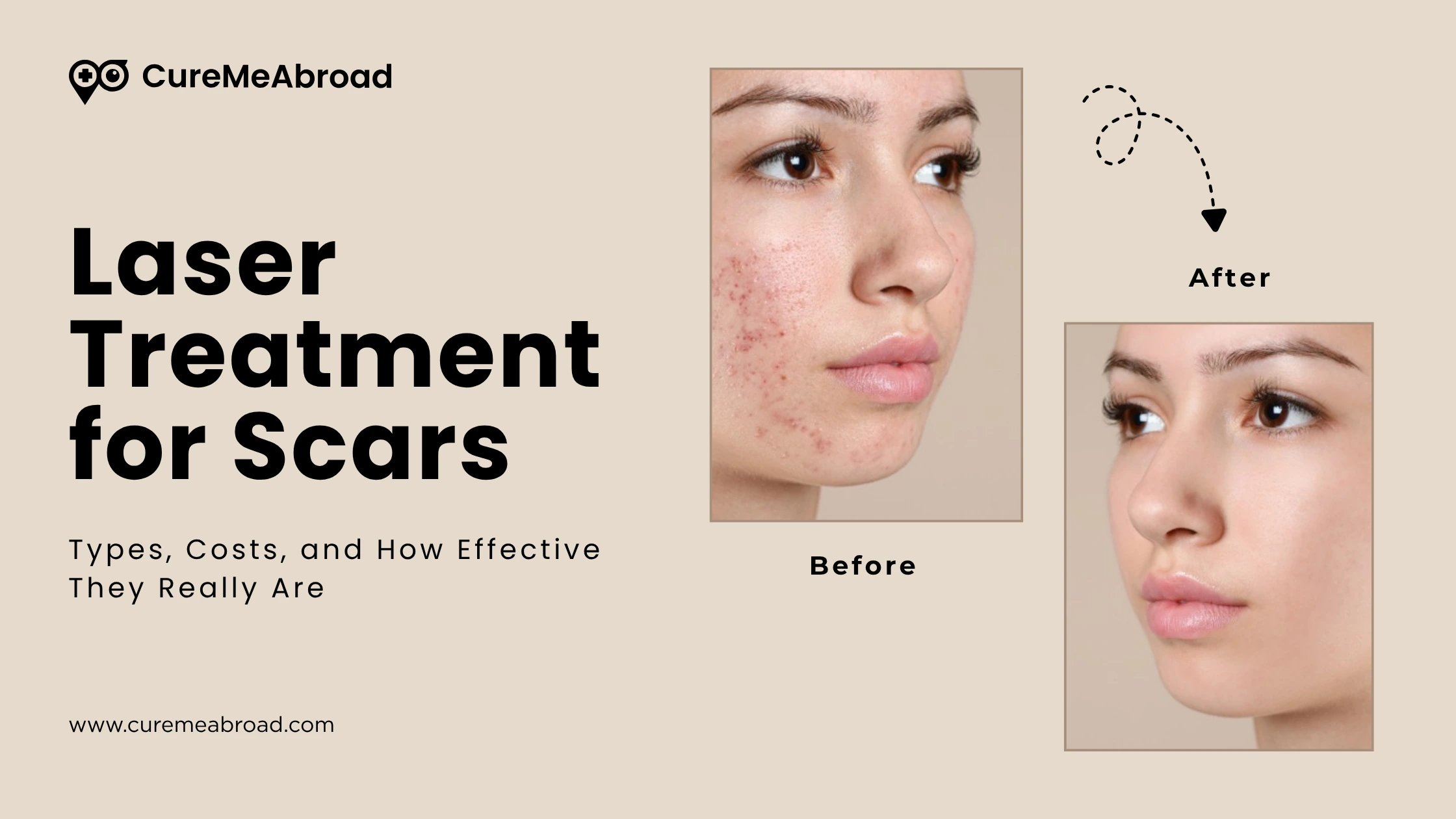 Laser Treatment for Scars: Types, Costs, and How Effective They Really Are