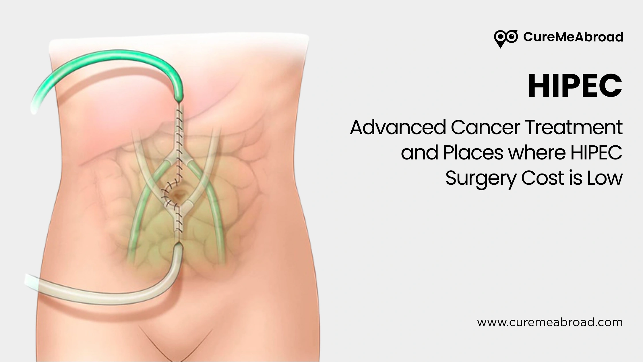 HIPEC: Advanced Cancer Treatment and Places where HIPEC Surgery Cost is Low