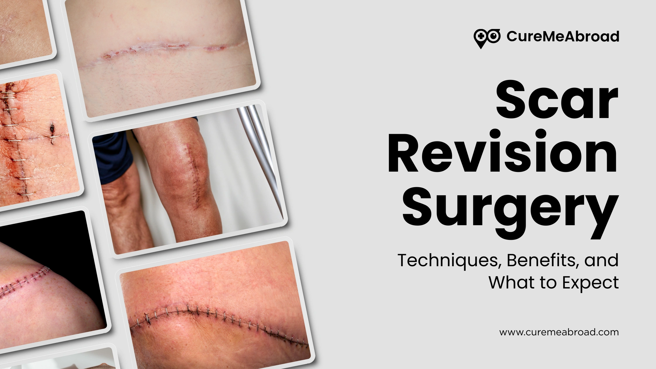 Scar Revision Surgery: Techniques, Benefits, and What to Expect