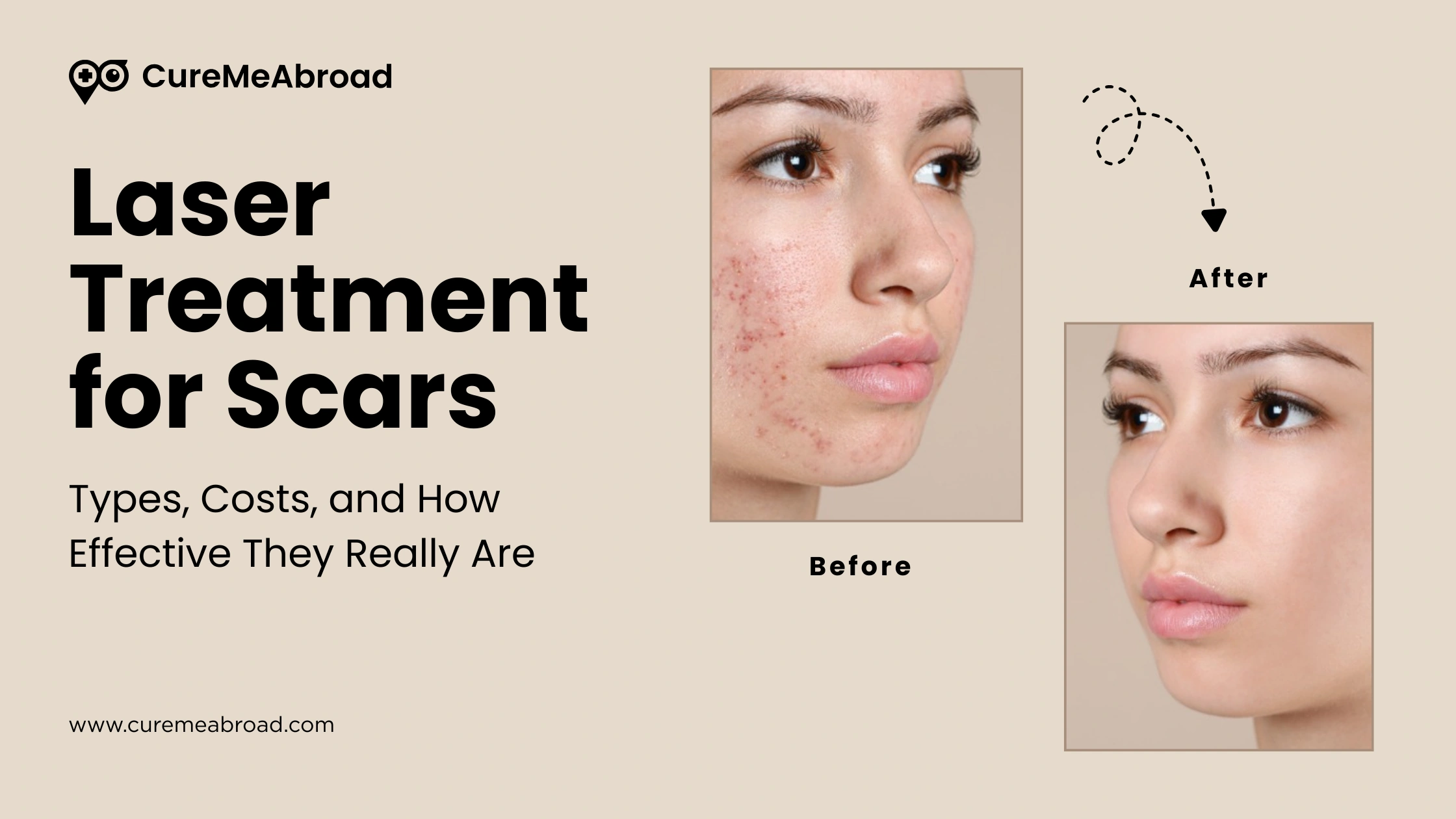 Laser Treatment for Scars: Types, Costs, and How Effective They Really Are