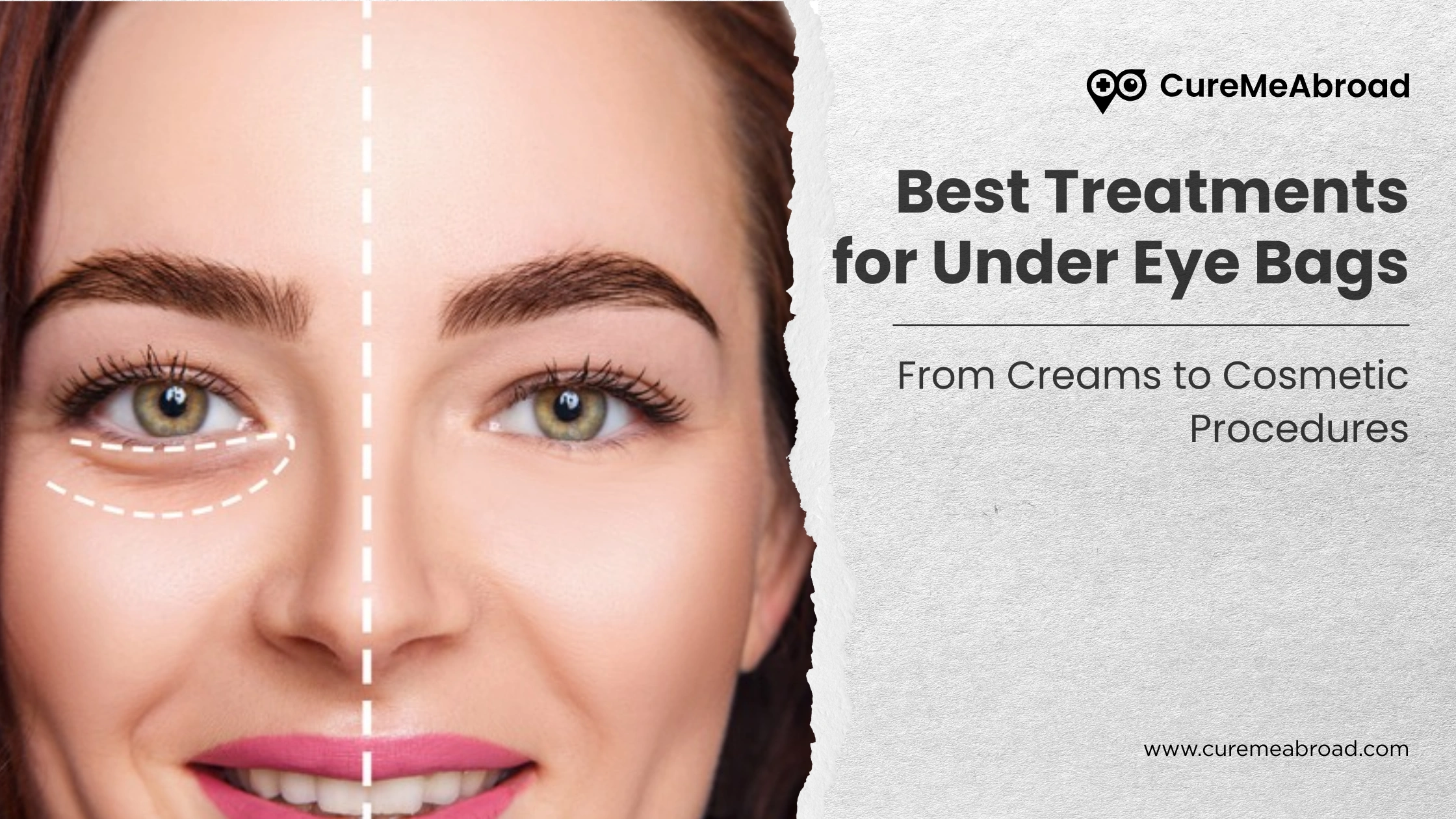 Best Treatments for Under Eye Bags: From Creams to Cosmetic Procedures