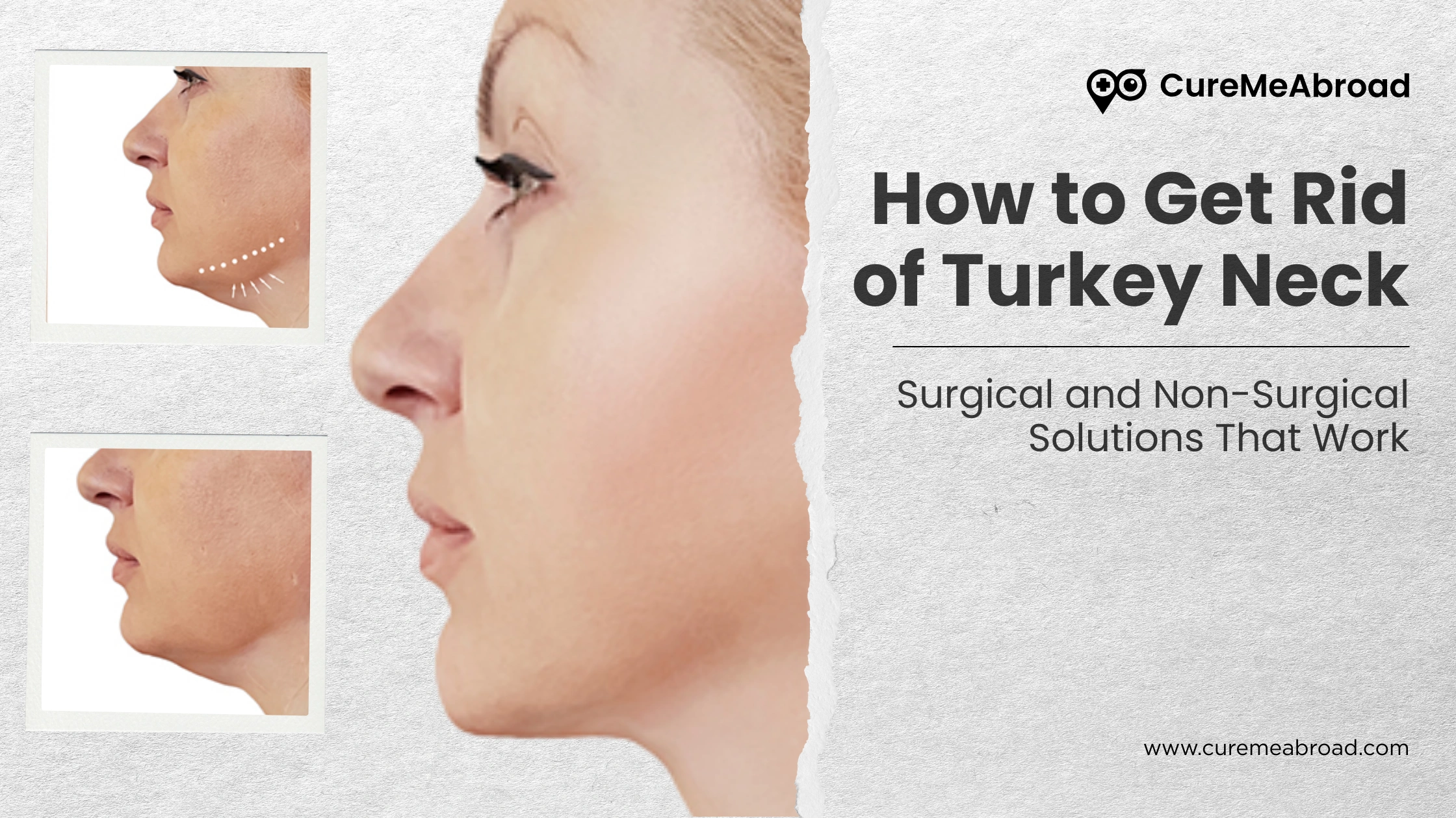 How to Get Rid of Turkey Neck: Surgical and Non-Surgical Solutions That Work
