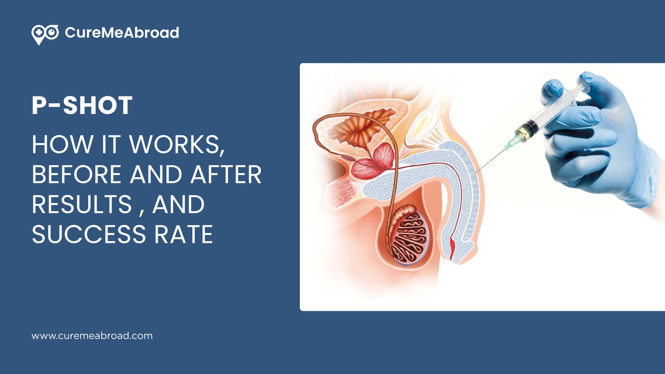 P-SHOT: HOW IT WORKS, BEFORE AND AFTER RESULTS, AND SUCCESS RATE