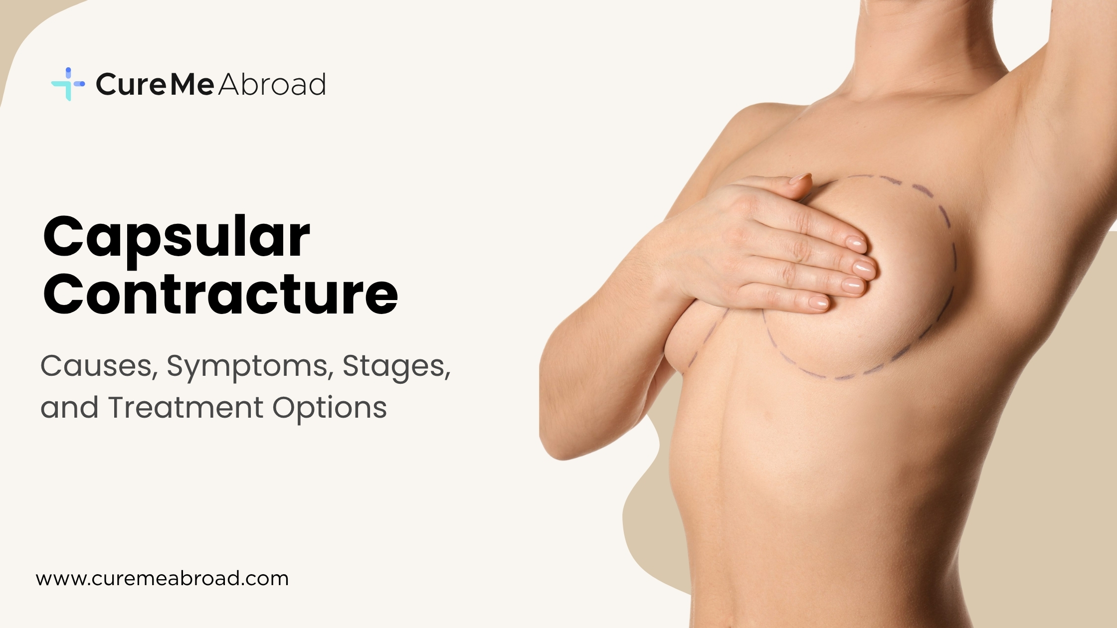 Capsular Contracture: Causes, Symptoms, Stages, and Treatment Options