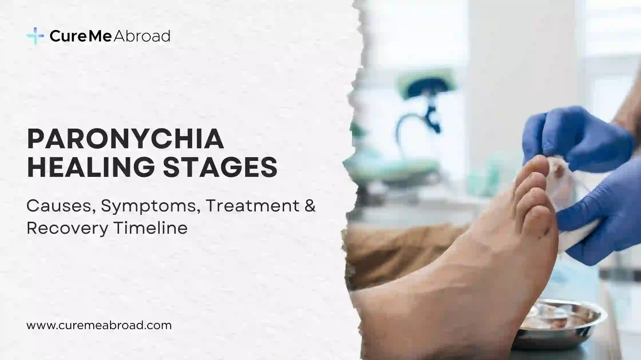 Paronychia Guide: Causes, Symptoms and Treatment Options