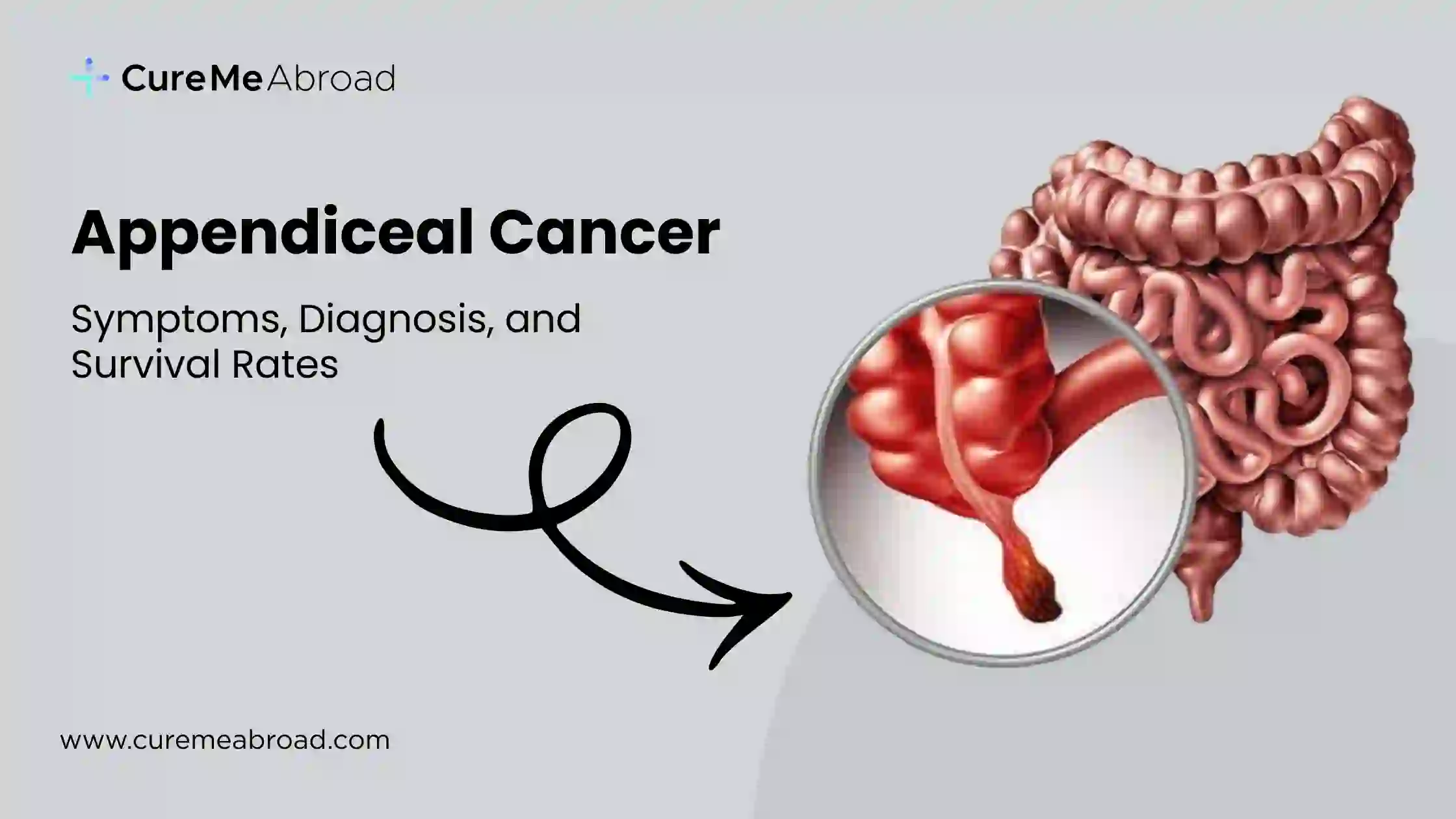 Appendiceal Cancer Explained: Symptoms, Diagnosis, and Survival Rates