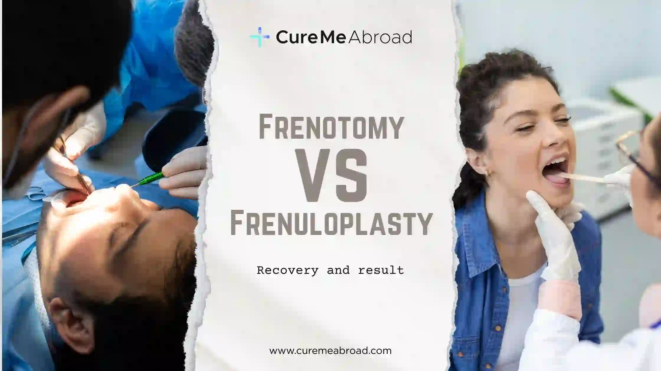 Tongue Tie Surgery Explained: Frenotomy vs Frenuloplasty, Recovery, and Results