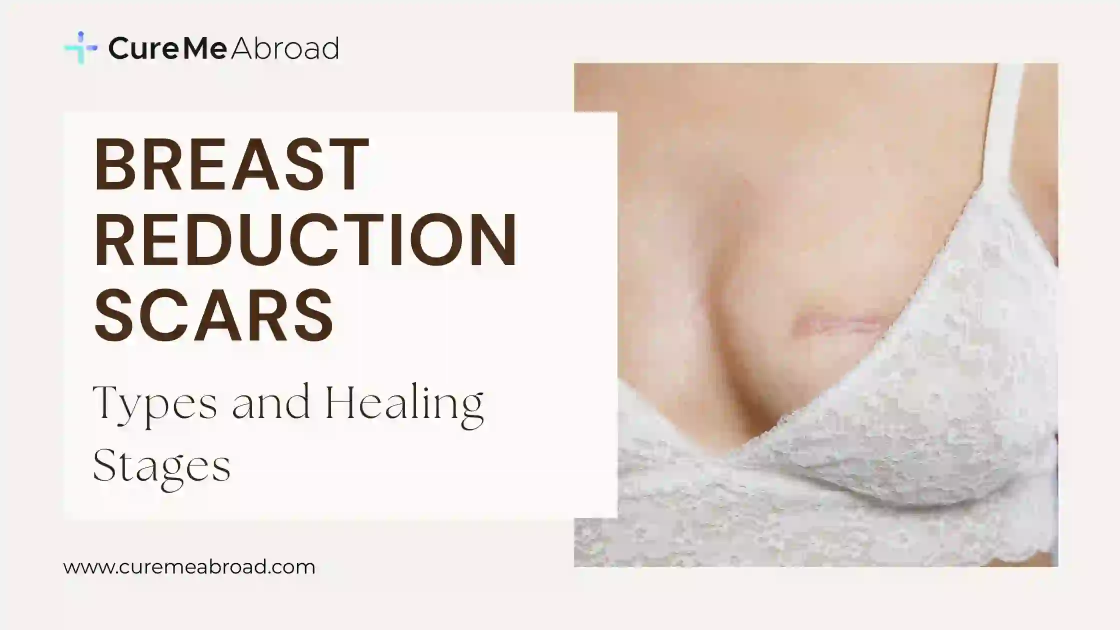 Breast Reduction Scars: Types and Healing Stages