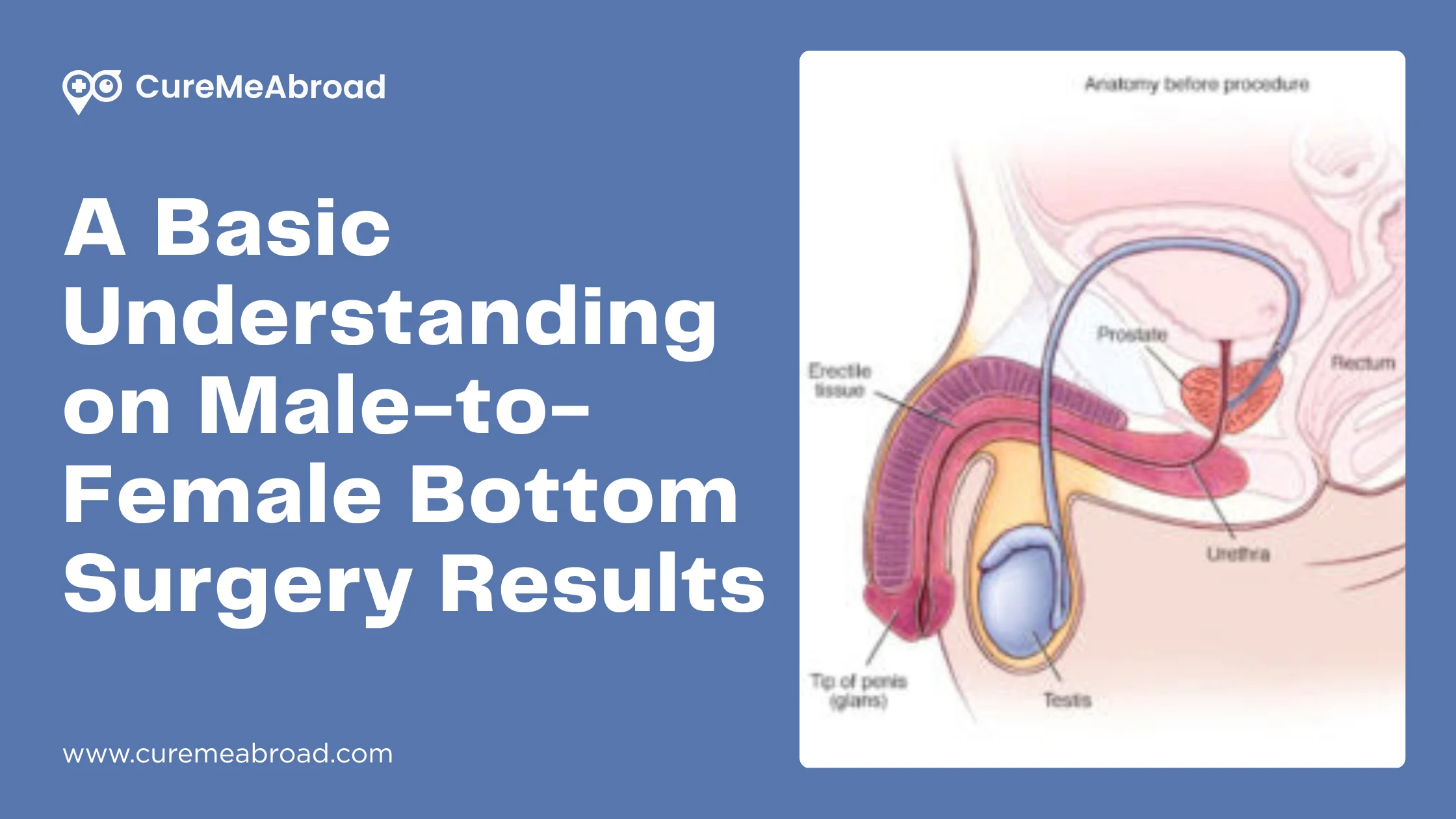 A Basic Understanding on Male-to-Female Bottom Surgery Results