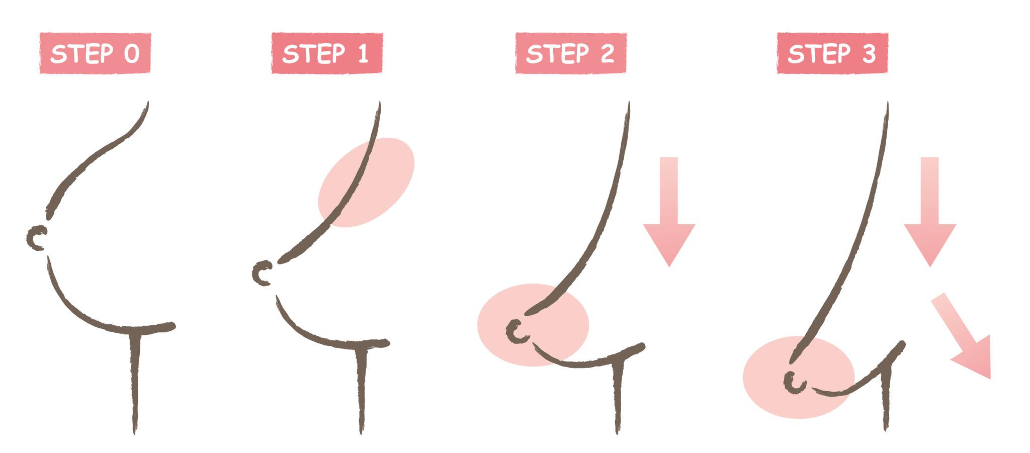 breast losing shape stages