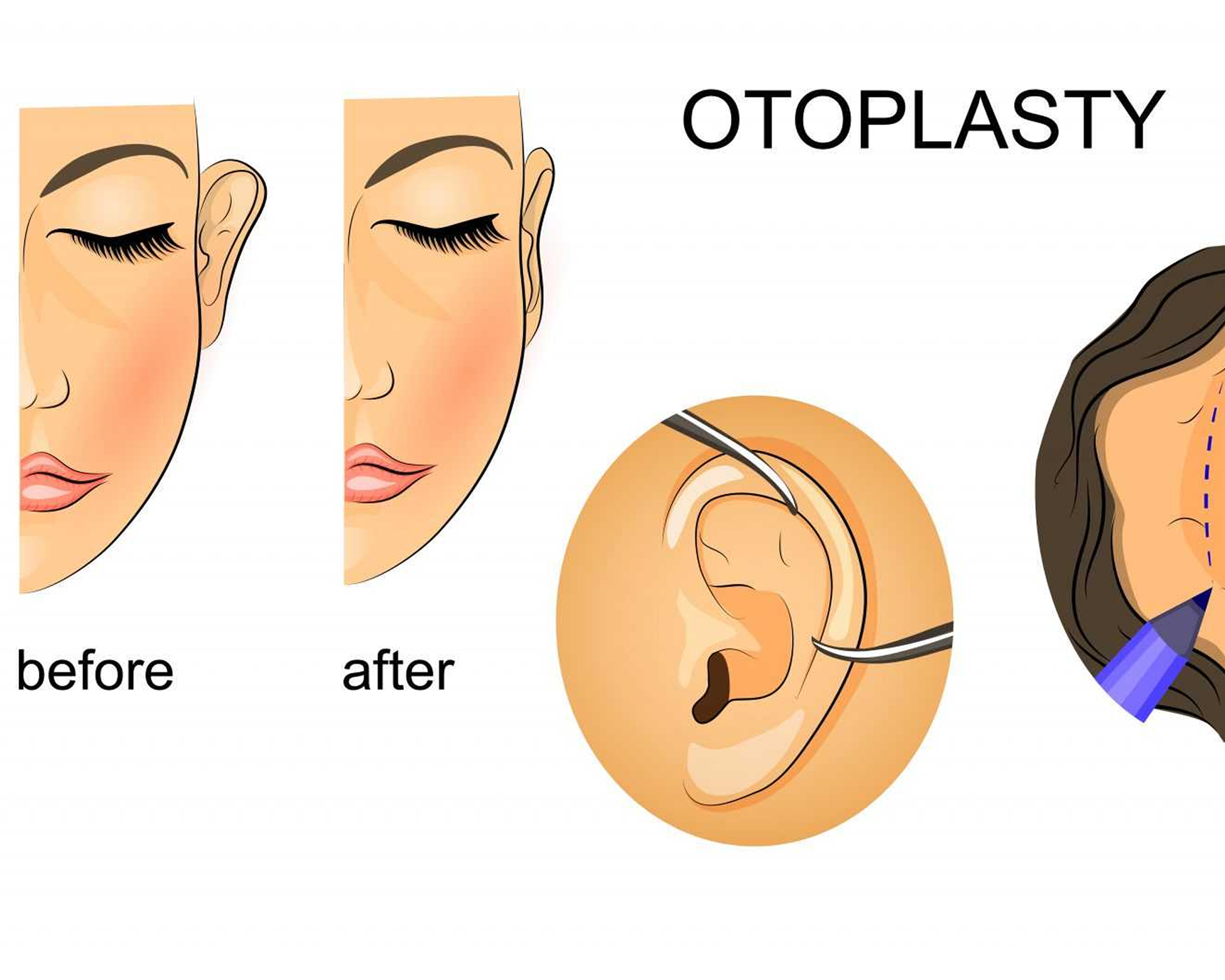 1. Ear Otoplasty Surgery  Everything You Need to Know 3