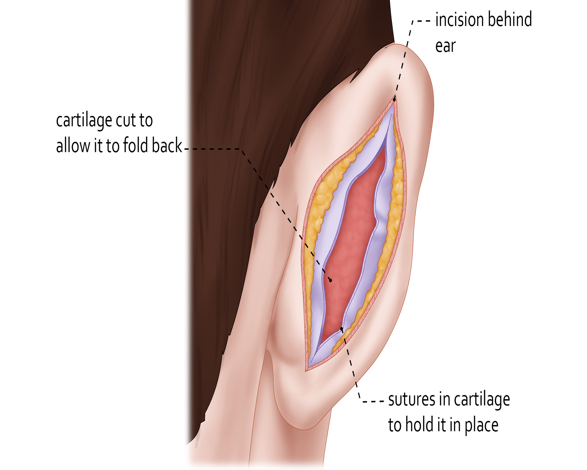 1. Ear Otoplasty Surgery  Everything You Need to Know 2