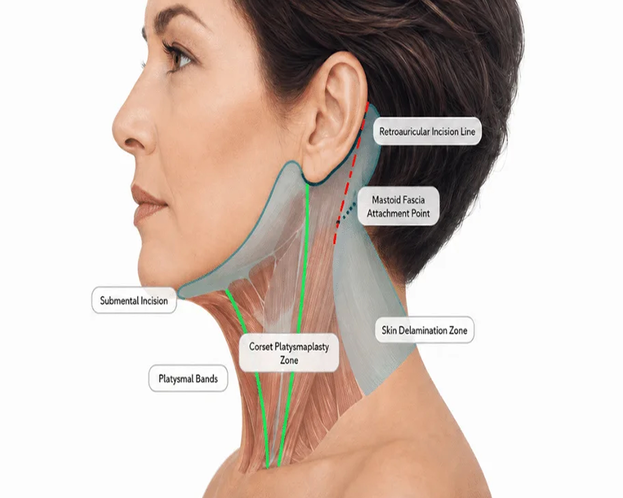 3. What Is a Deep Plane Neck Lift The Advanced Technique for Natural Results 2