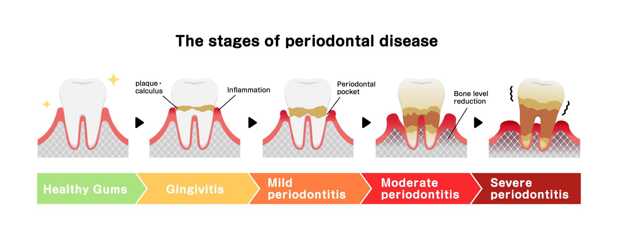 The stages of periodontal disease