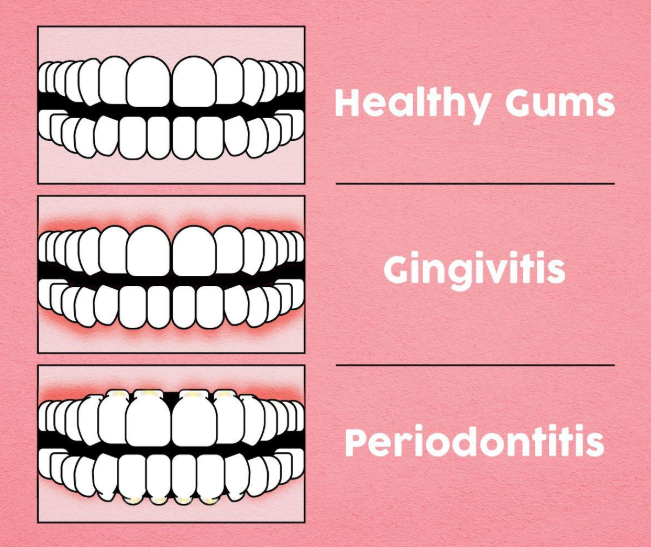 gum diseases