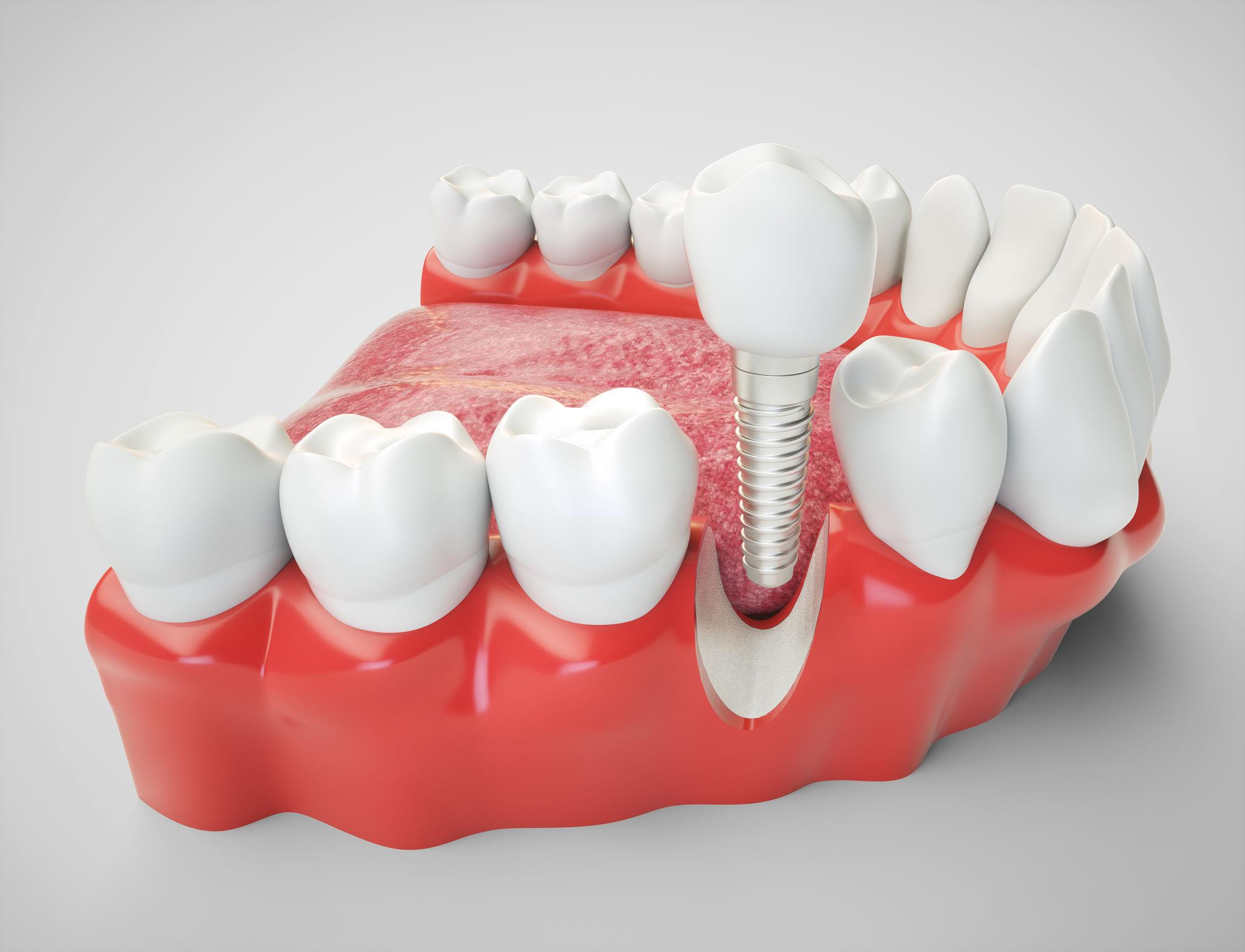 what is a dental implants