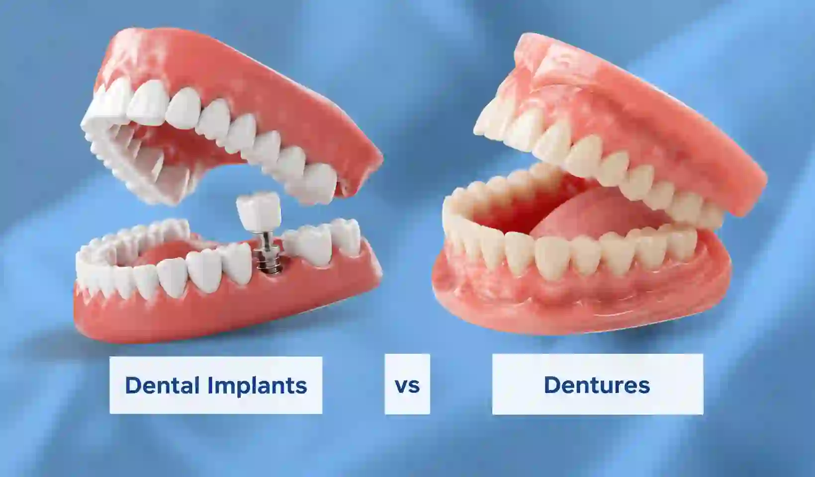 Why Dental Implants Are Better Than Dentures for Seniors