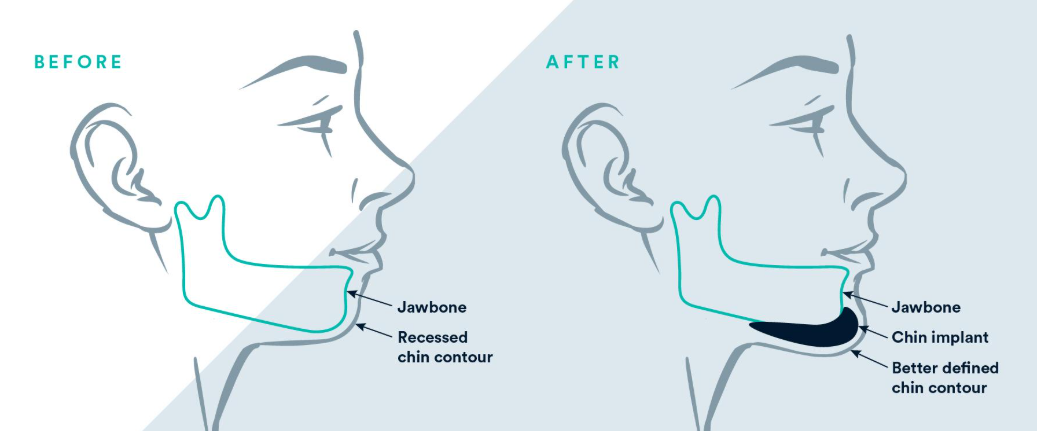 Chin Augmentation