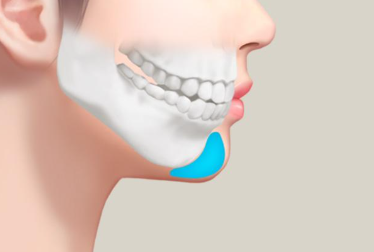 Chin Augmentation.