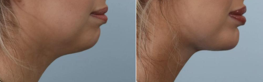 before after chin augmentation