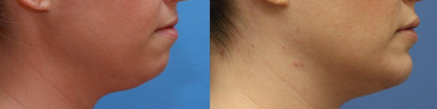before after chin augmentation (2)