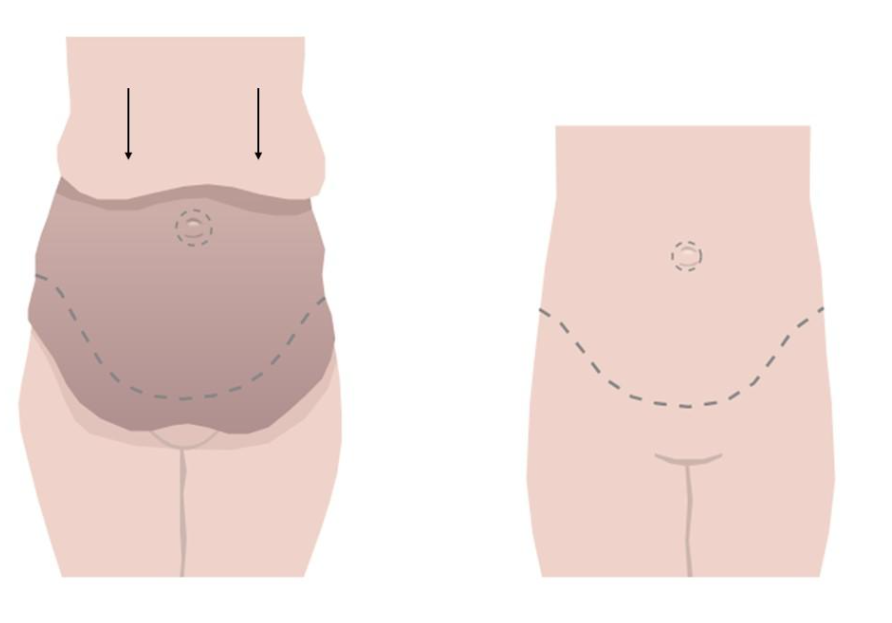 Lower Body Lift images