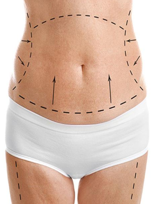 Lower Body Lift images (2)