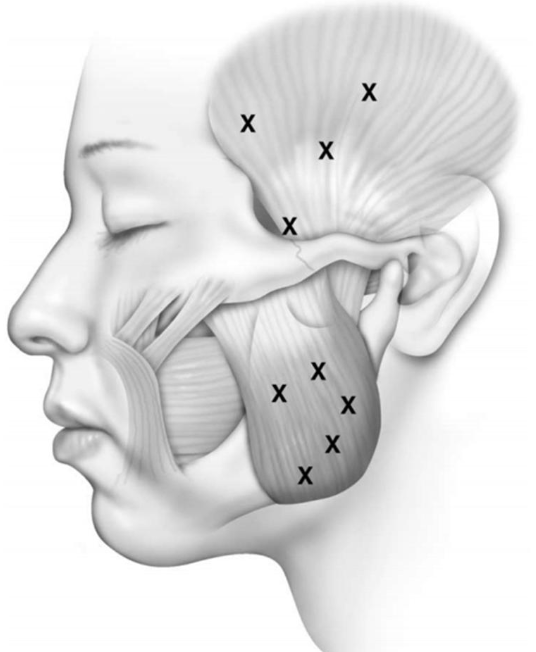 Botox for TMJ images
