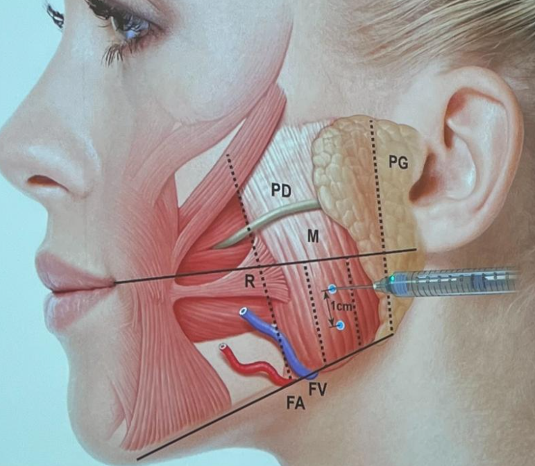 Botox for TMJ images (2)