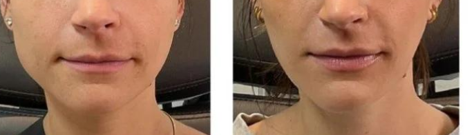 Before and after Botox for TMJ