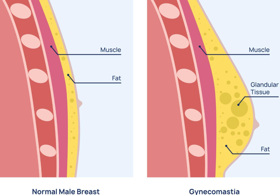 Gynecomastia images