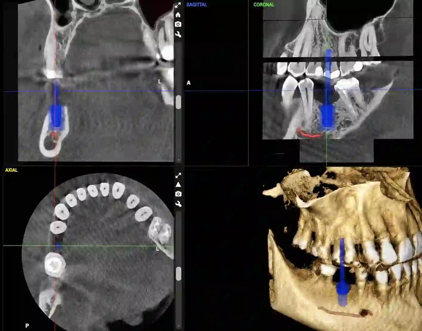 Subperiosteal Implant images
