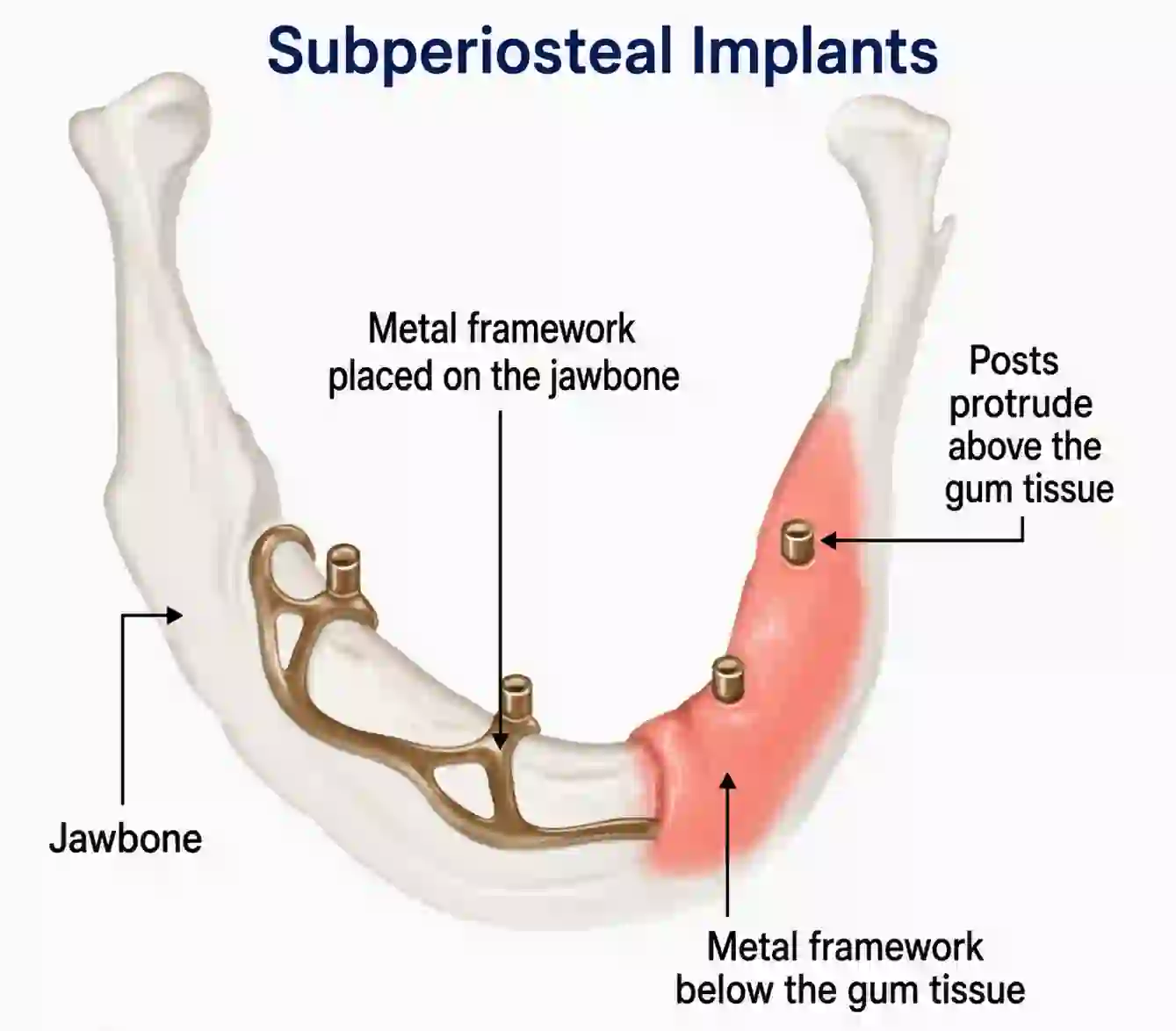 Subperiosteal Implantcompressed