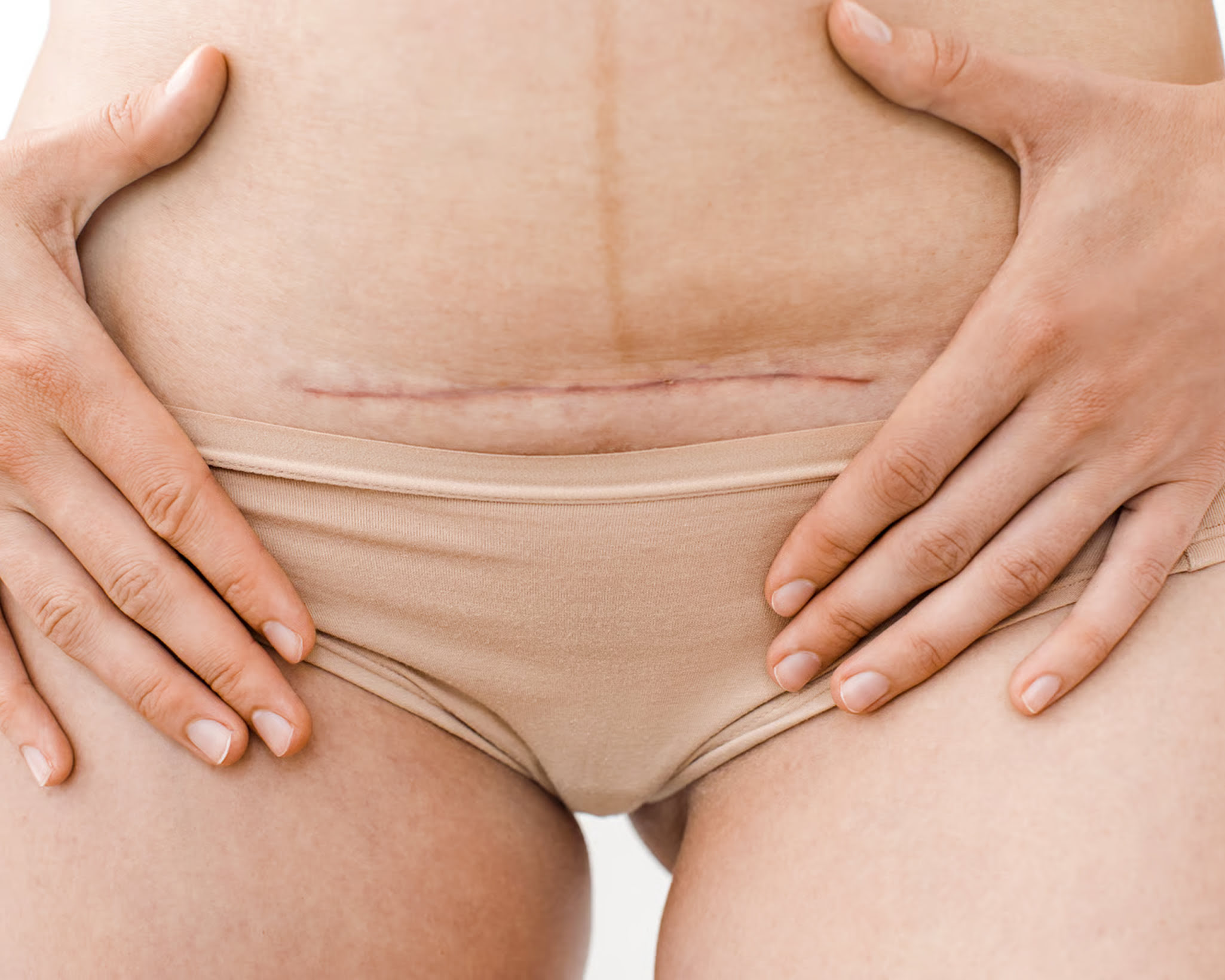 7. Tummy Tuck Scar Healing Stag (1)