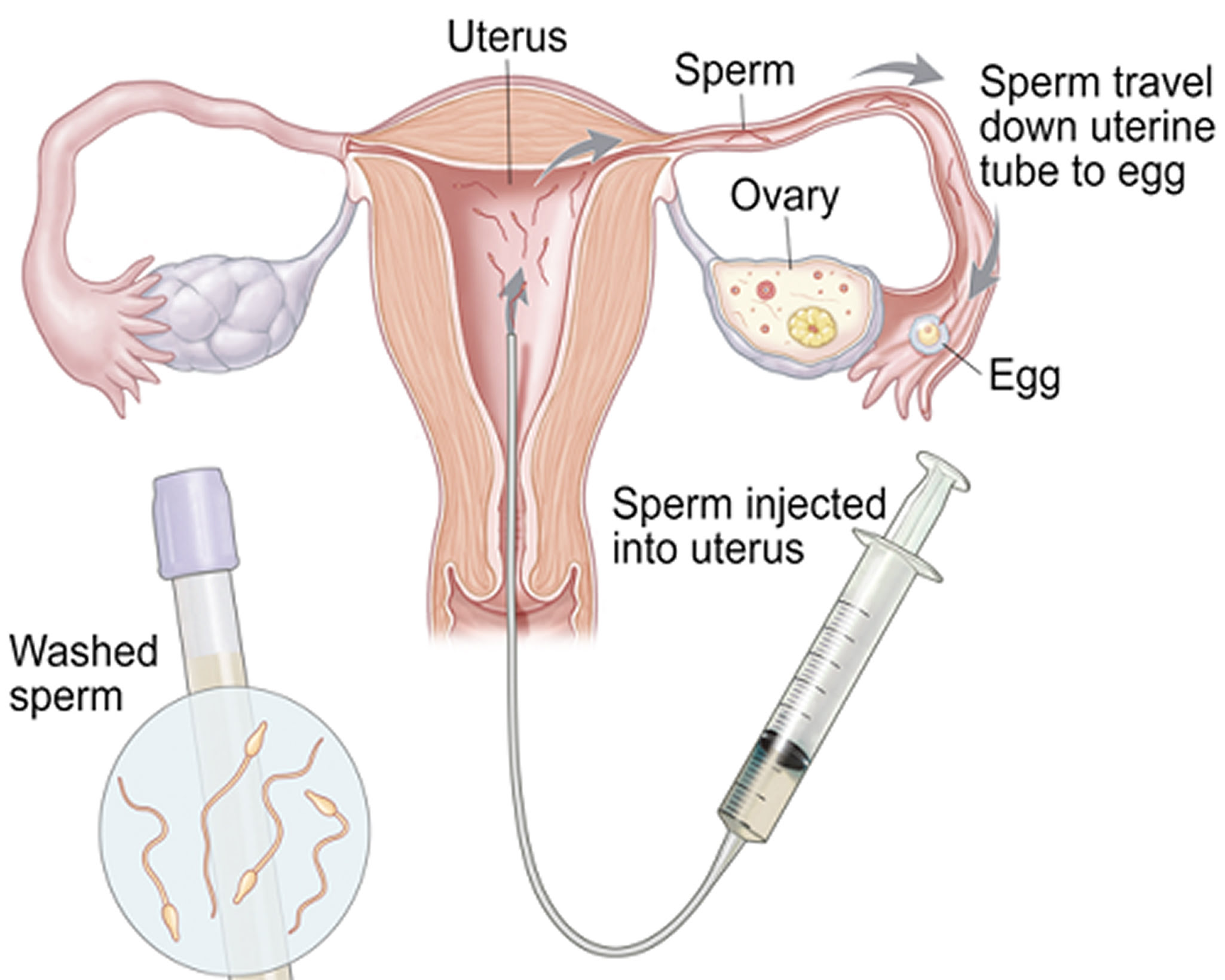 10. Natural Insemination Explain (1)