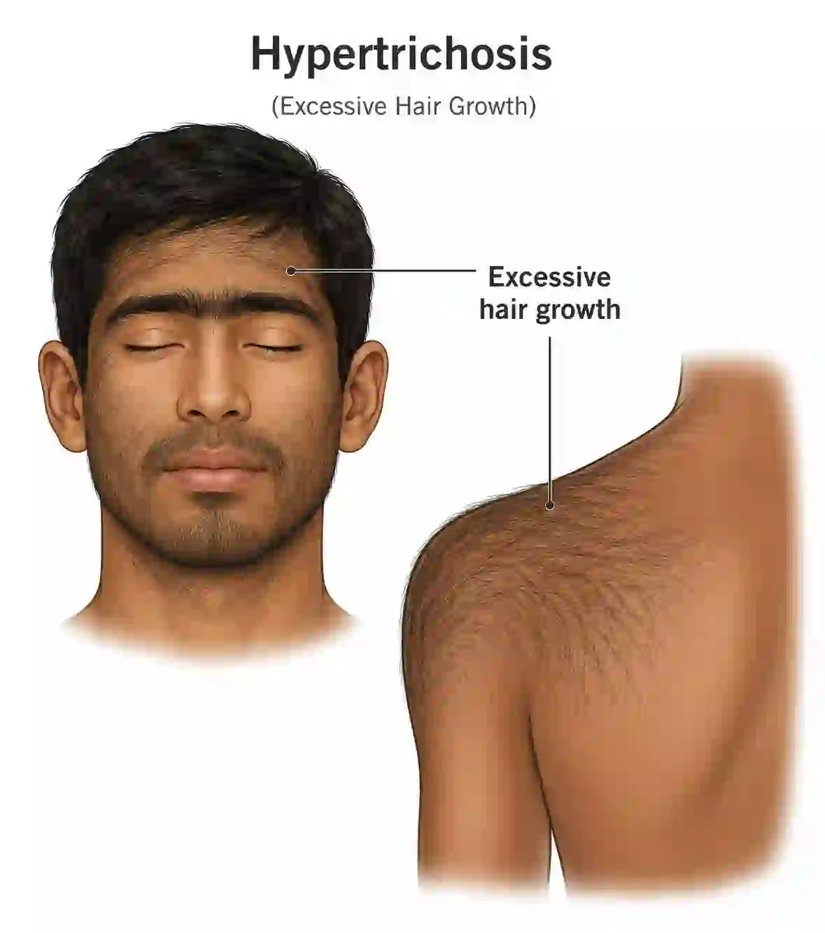 image of werewolf syndromecompressed 